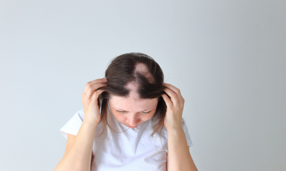 SIH Alopecia treatments