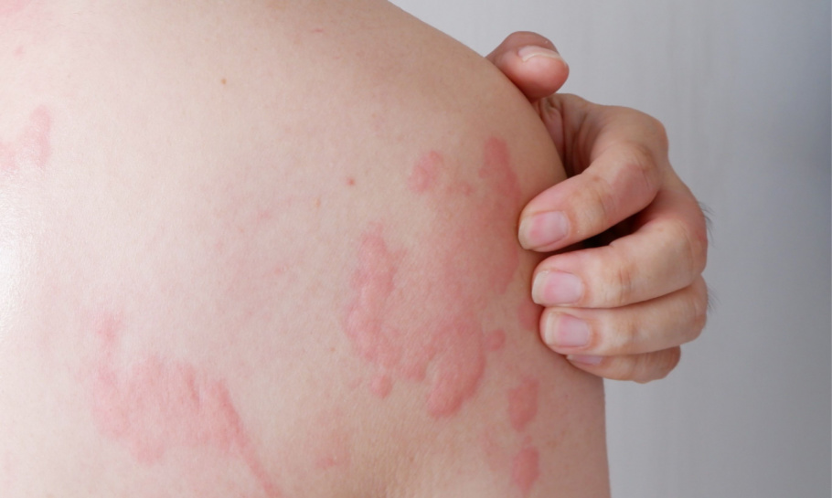 SIH Hives treatments