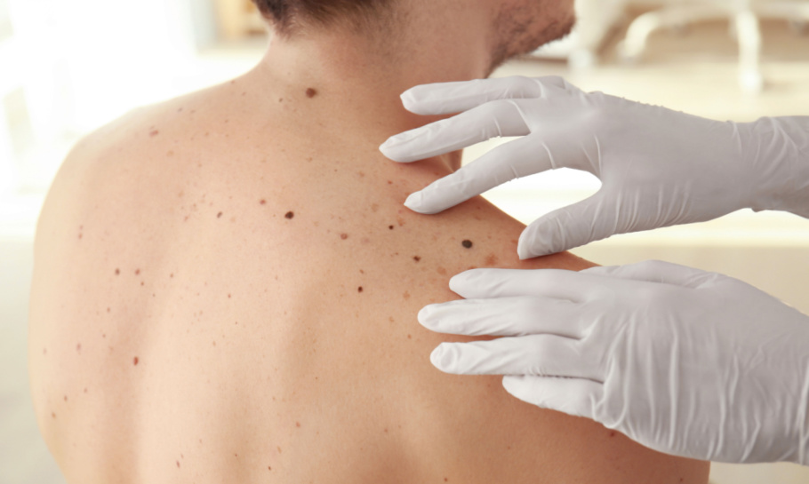 SIH Melanoma treatments