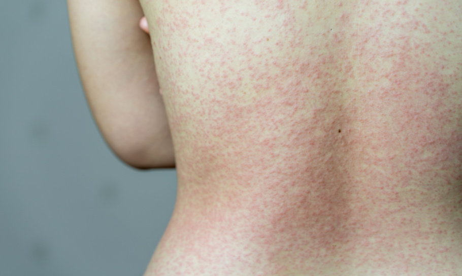 SIH Rash treatments