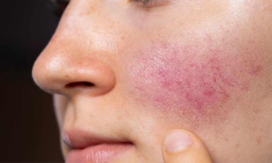 SIH Rosacea treatments